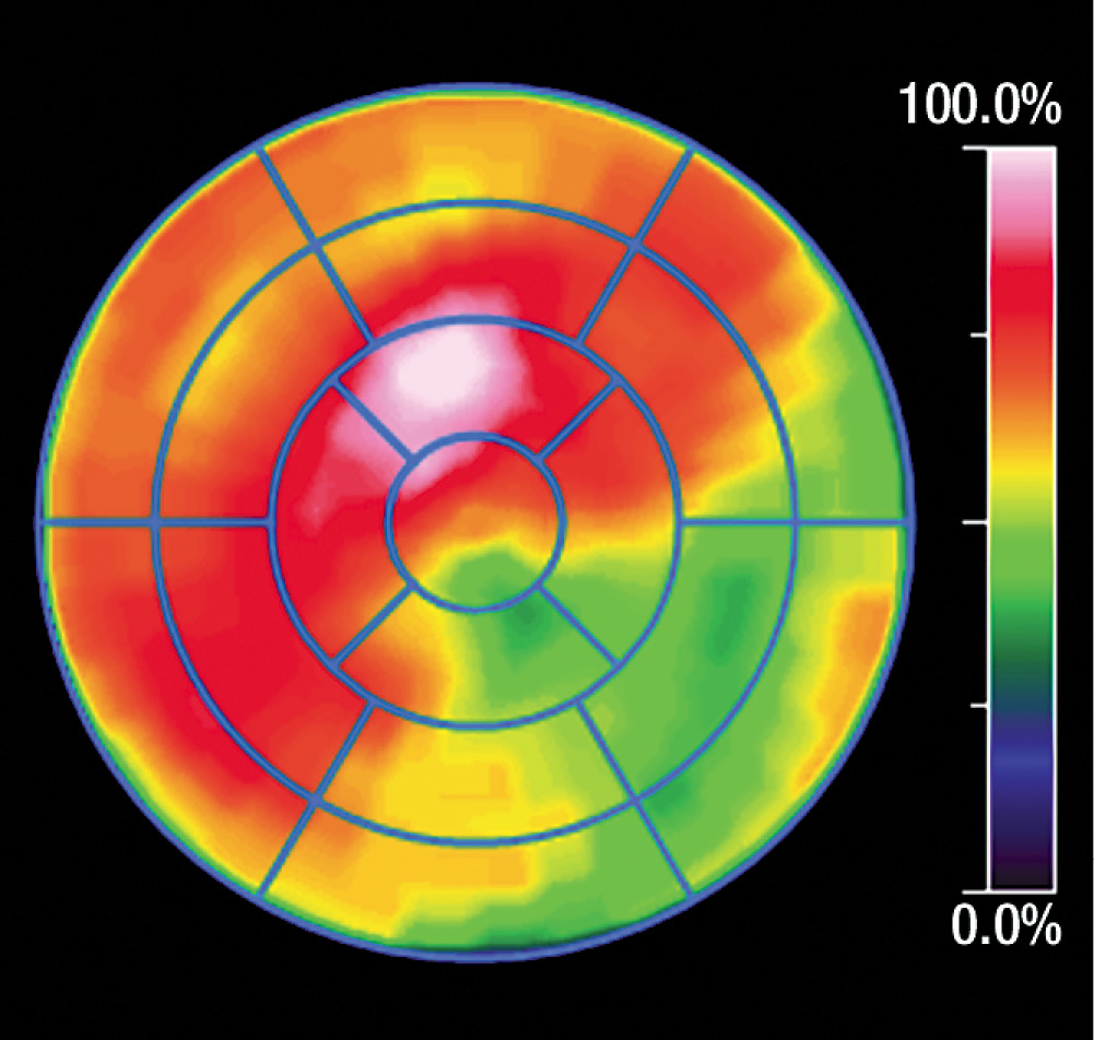 Cardiac PET/MR imaging with fluorine 18 fluorodeoxyglucose (FDG)